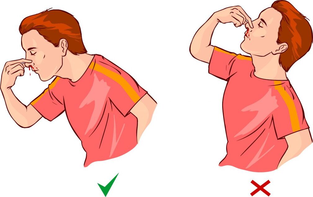 Epistaxia pre hypertenziu